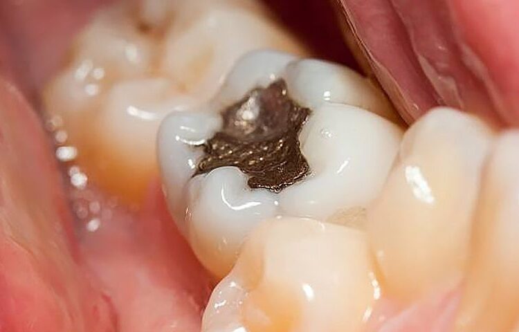 how long does it take to fill a cavity