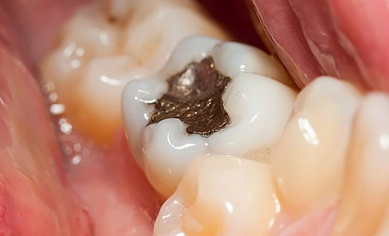 how long does it take to fill a cavity