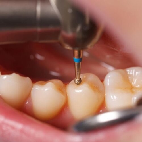 how long does it take to fill in a cavity
