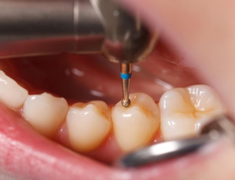 how long does it take to fill in a cavity