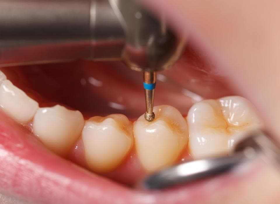 how long does it take to fill in a cavity