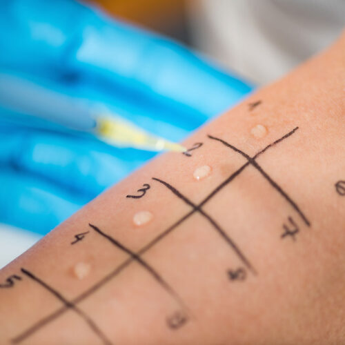 how to book an allergy test nhs