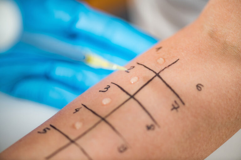 How to Book an Allergy Test NHS - Digital Journal
