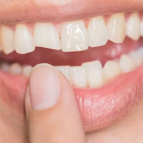 how to fix a cracked tooth naturally