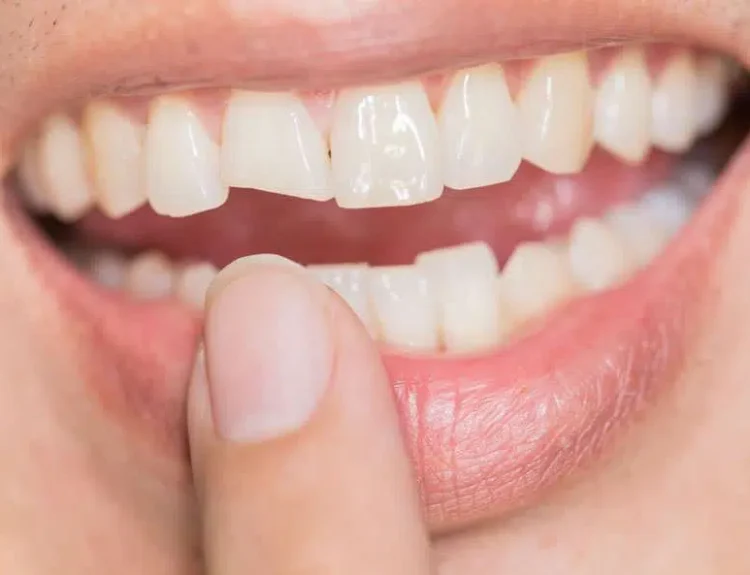 how to fix a cracked tooth naturally